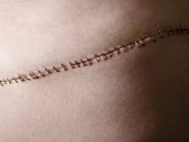 Narbenbildung - ist sie gefährlich?