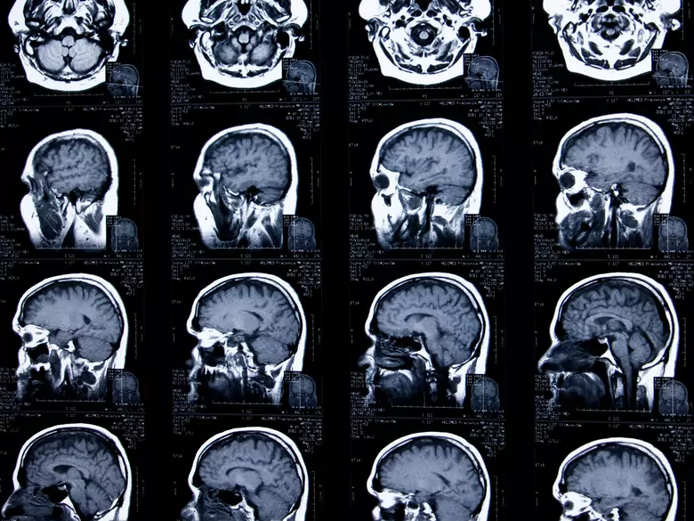 Zirbeldrüse-Zyste - Ursachen, Symptome, Diagnose, Behandlung