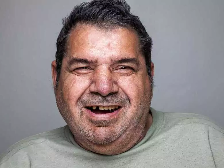 Warum kann Fettleibigkeit das Risiko einer Parodontalerkrankung erhöhen?