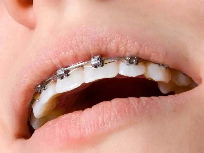 Moderne kieferorthopädische Geräte mit selbstligierenden Brackets