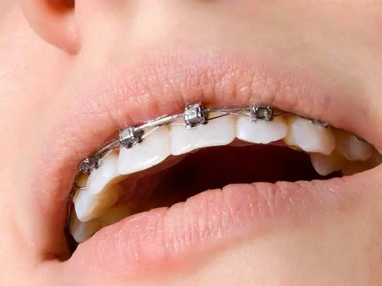 Malokklusionsdiagnose