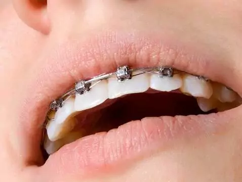 Malokklusionsdiagnose