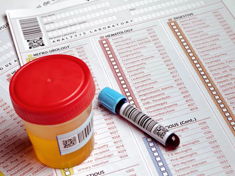 Pseudohypoparathyreoidismus - Ursachen, Symptome, Diagnose, Behandlung