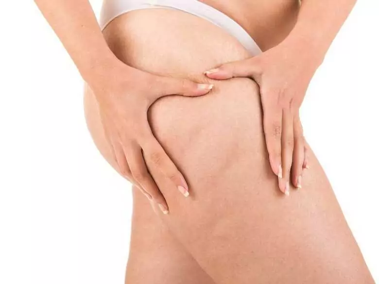 Lipodemie - 'Fettbein'-Krankheit