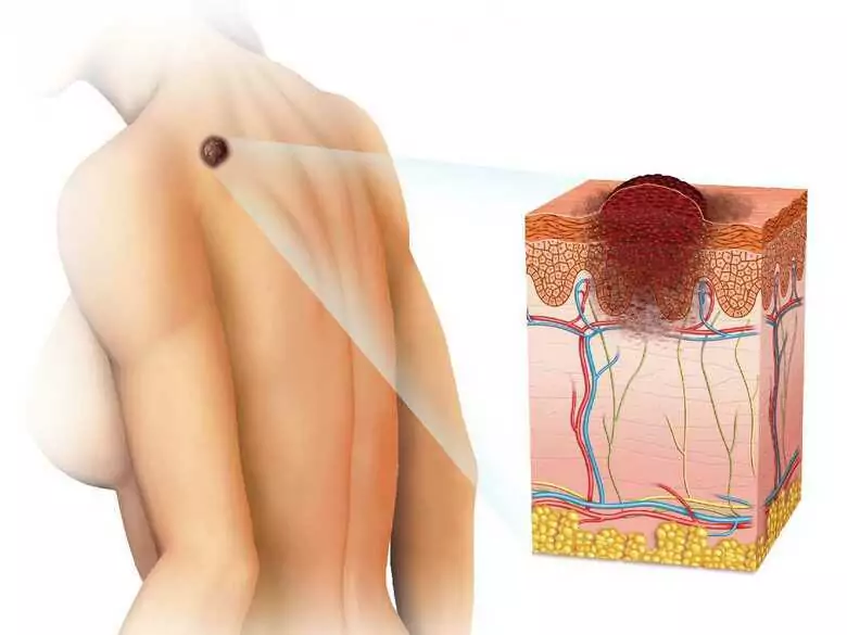 Hautkrebs und Vorstufen von Krebs