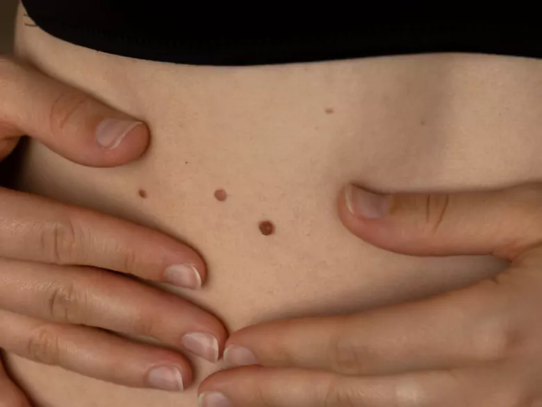 Neuer Weg für Wissenschaftler zur Erkennung von Hautkrebs