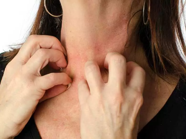 Epidemiologie der Kontaktallergie gegen Nickel