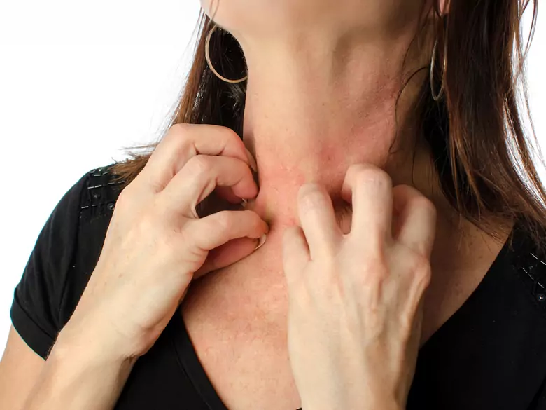 Systemischer Lupus erythematodes (SLLE) - Pathogenese, Symptome und Behandlung