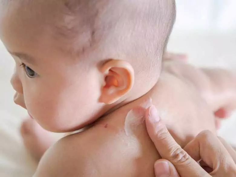 Ekzeme bei Kindern - die Auswirkungen des Stillens