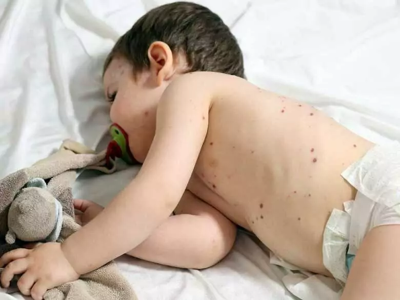 Masern - droht uns eine Epidemie?