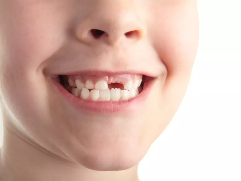 Karies der Milchzähne - Ursachen, Symptome, Diagnose, Behandlung