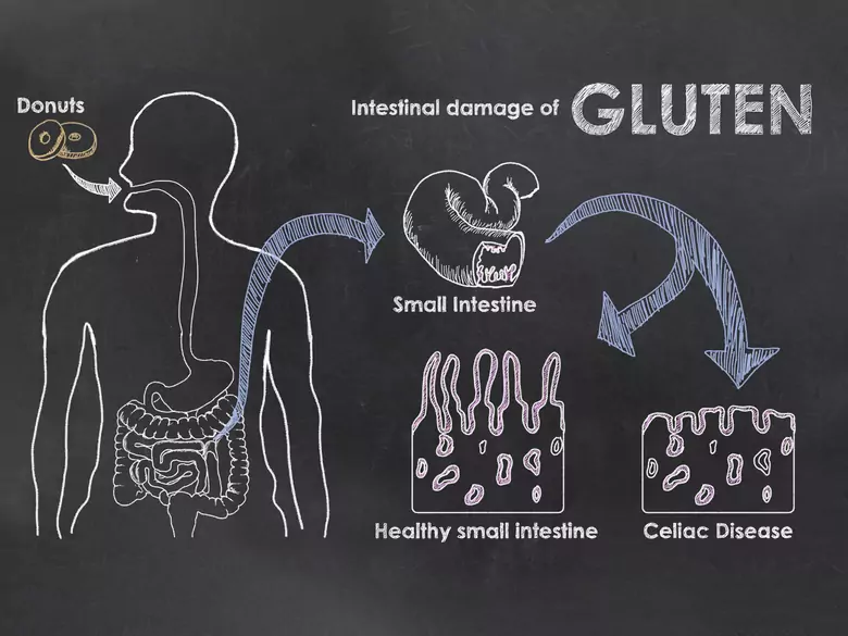Korrelation zwischen Gluten und Migräne. Ist das möglich?