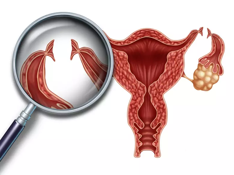 Neuer Test zur Früherkennung von Eierstockkrebs?