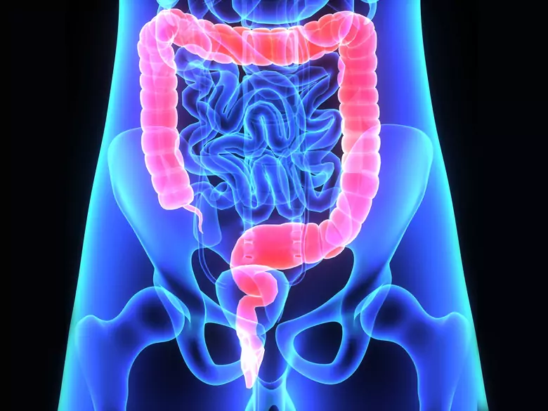 Darmkrebs - Versuchen Sie, ihn zu verhindern