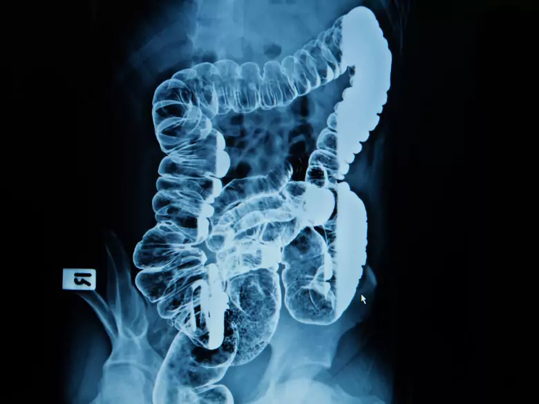 Kolorektales Karzinom - Ursachen, Symptome, Diagnose, Behandlung