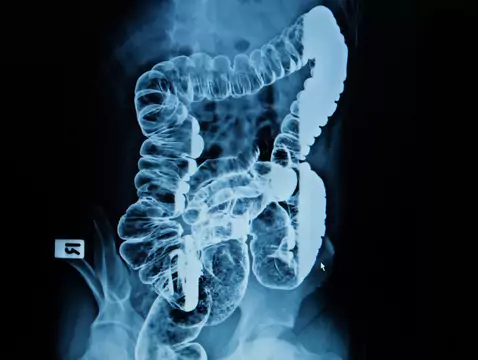 Kolorektales Karzinom - Ursachen, Symptome, Diagnose, Behandlung