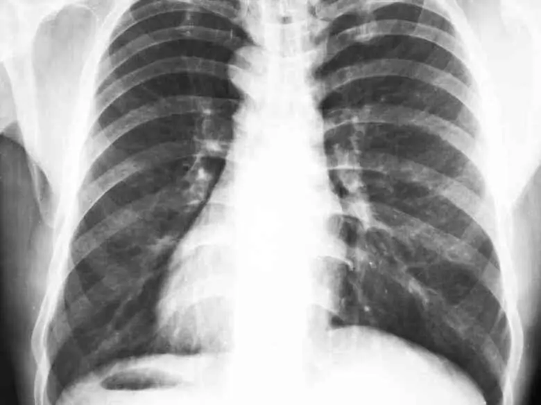 Röntgenaufnahme der Brust in der Kardiologie