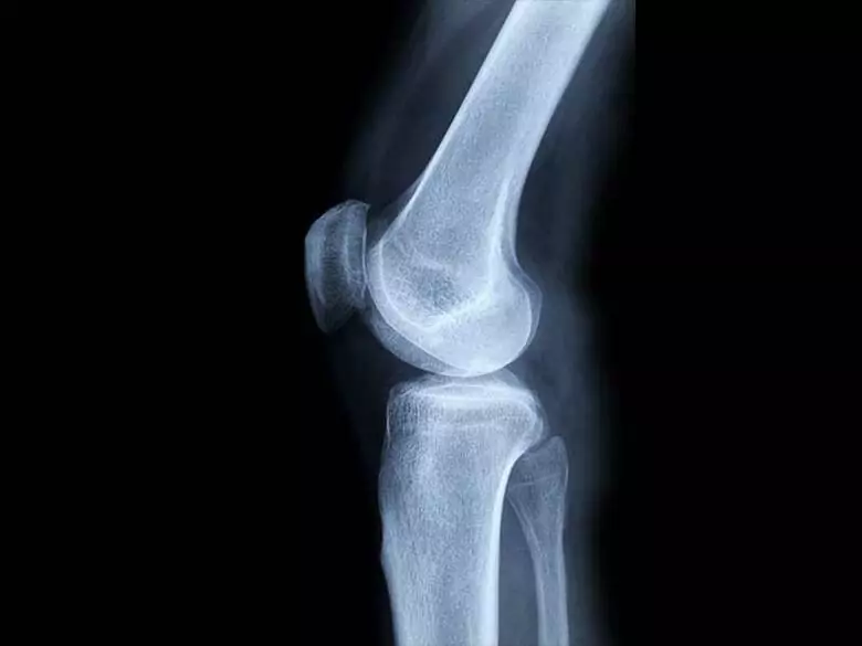 Bösartiger Knochentumor - Ursachen und Risikofaktoren