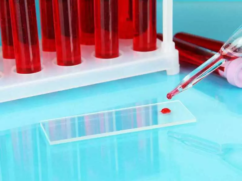 Coronavirus und Blutgruppe: spielt es eine Rolle, wann Sie krank werden?