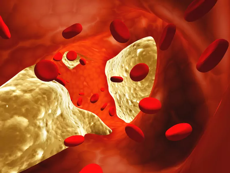 Alles, was Sie über Statine wissen müssen