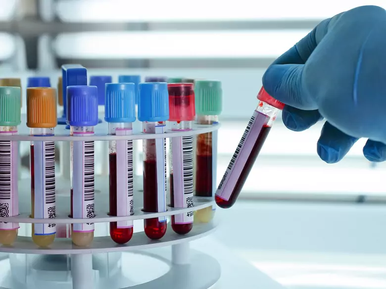 Was ist ein gesunder Cholesterinspiegel?