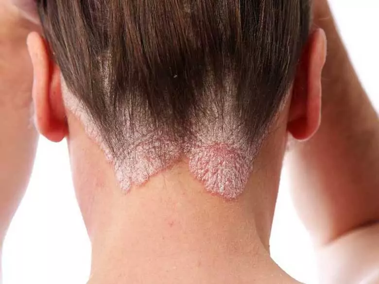 Was ist eine gesunde Ernährung für Menschen mit Psoriasis?