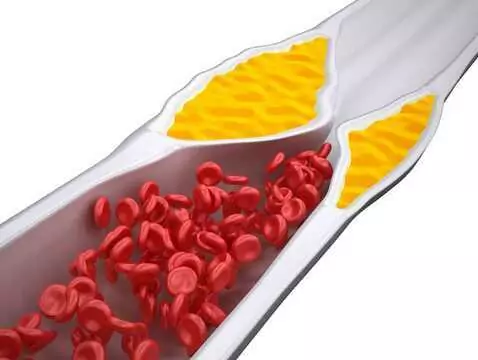 Familiäre Hypercholesterinämie - wenn ein Kind einen zu hohen Cholesterinspiegel hat