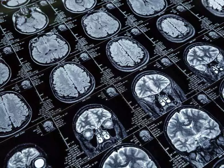 Häufigste Folgeerscheinungen eines ischämischen Schlaganfalls