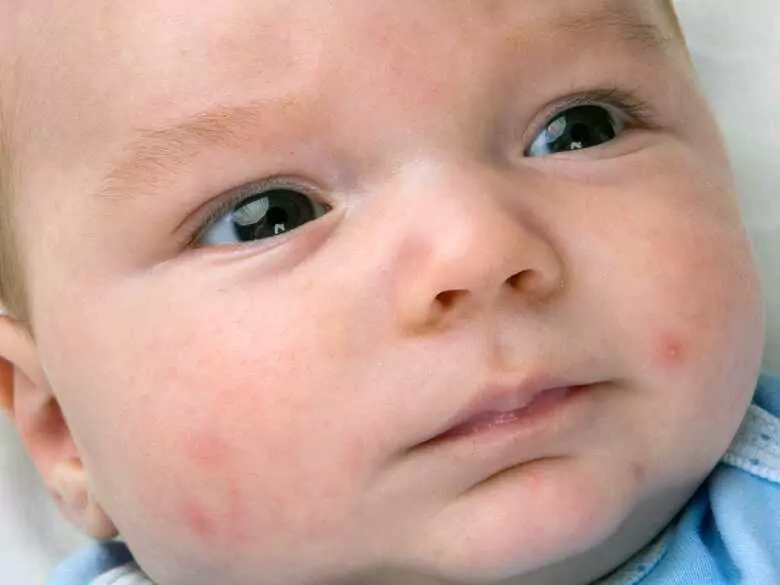 Lebensmittelallergie vs. Hautausschlag - was sollten Eltern wissen?