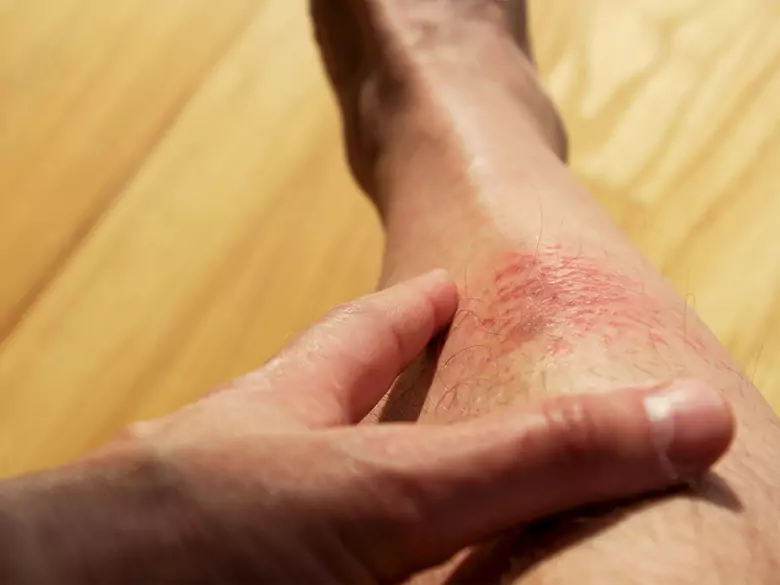 Pyoderma gangrenosum - was ist das?