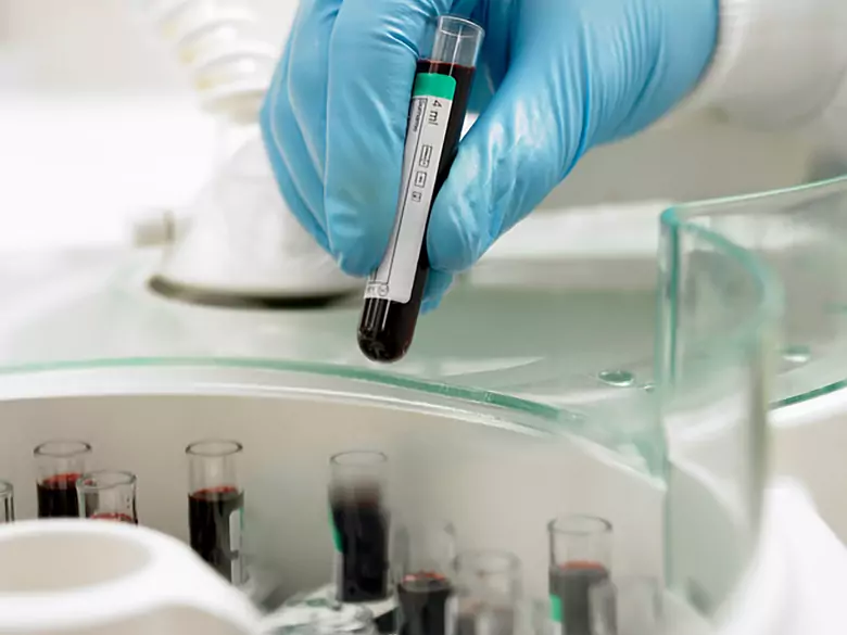 Anämie in der Schwangerschaft - Ursachen, Symptome, Diagnose, Behandlung