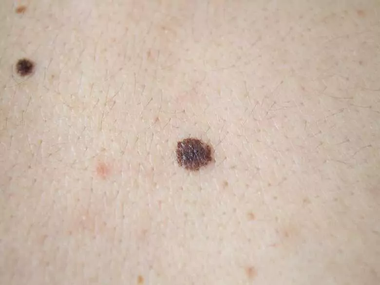 Beunruhigende Muttermale - was sollte Sie alarmieren?
