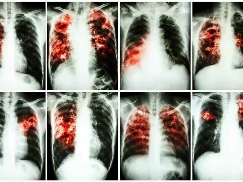Tschechische Wissenschaftler haben ein neues Medikament gegen Tuberkulose erfunden