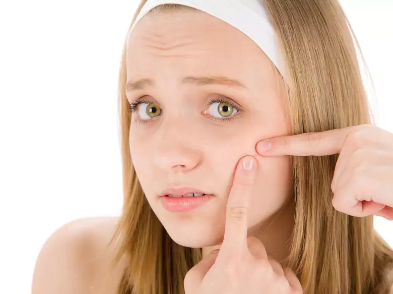 Pathogenese und Behandlung von Akne vulgaris