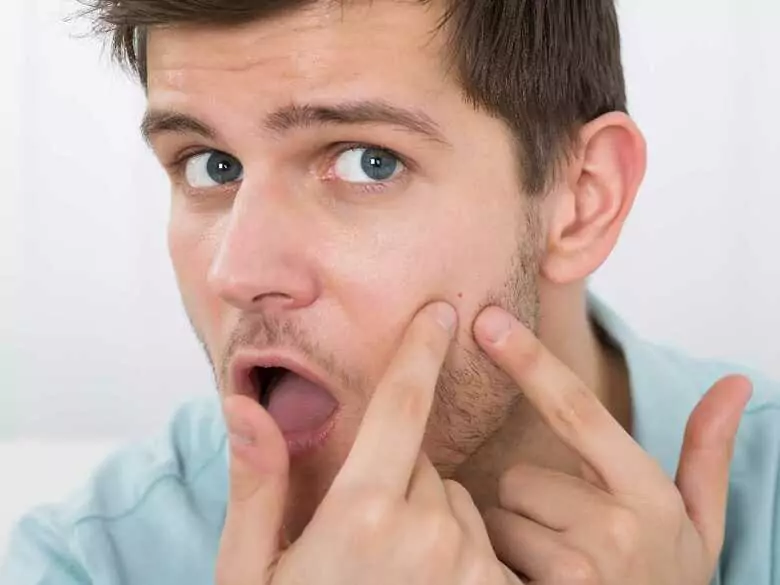 Akne bei Erwachsenen: Warum haben immer mehr 30-Jährige mit Hautläsionen zu kämpfen?