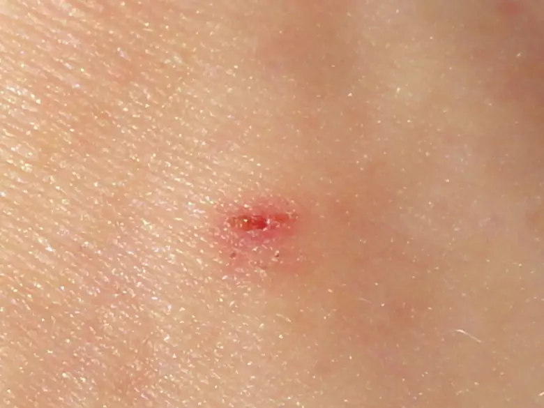 Regelmäßige Naevuskontrollen können Leben retten