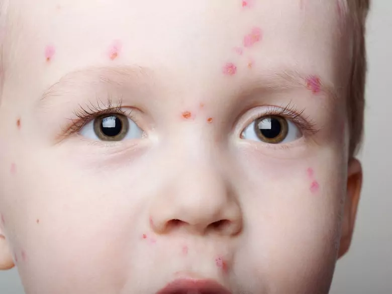 Kann Seife allergen sein?