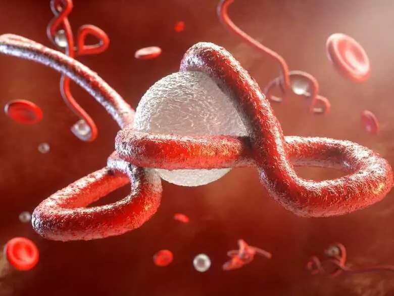 Primäre Hämochromatose - Ursachen, Symptome, Diagnose, Behandlung