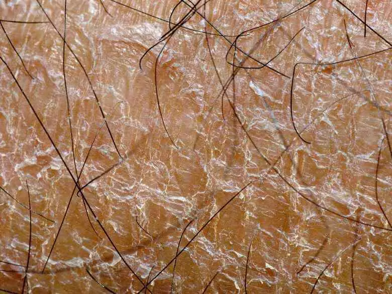 Wie behandelt man Probleme mit Seborrhoe?