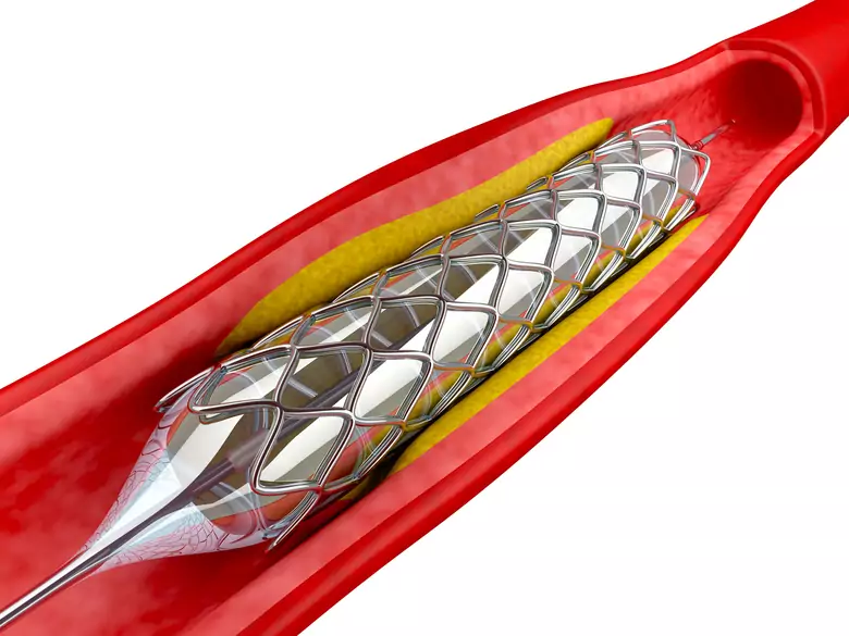 Aortenaneurysma - Ursachen, Symptome, Diagnose, Behandlung