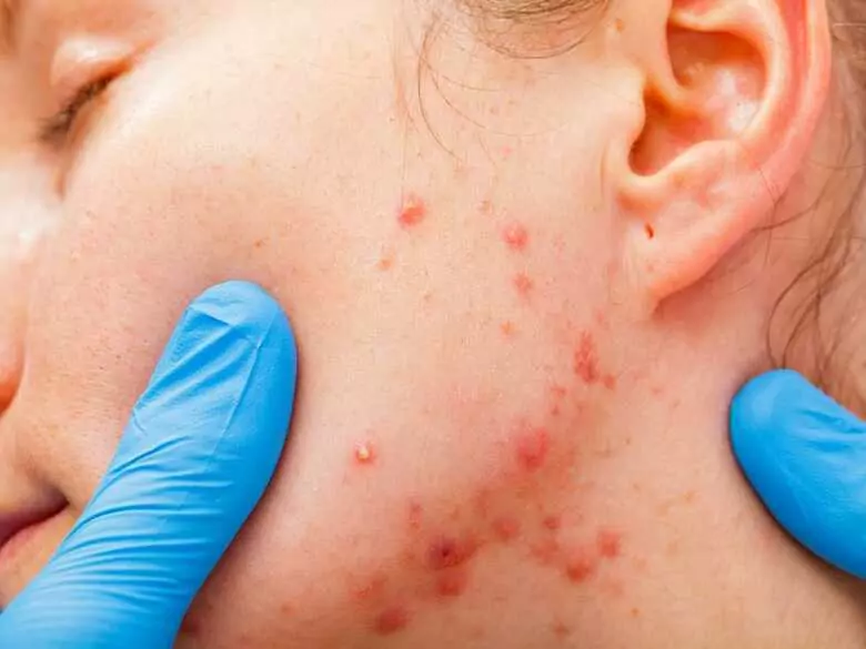 Akne: Wann sollte man einen Dermatologen aufsuchen?