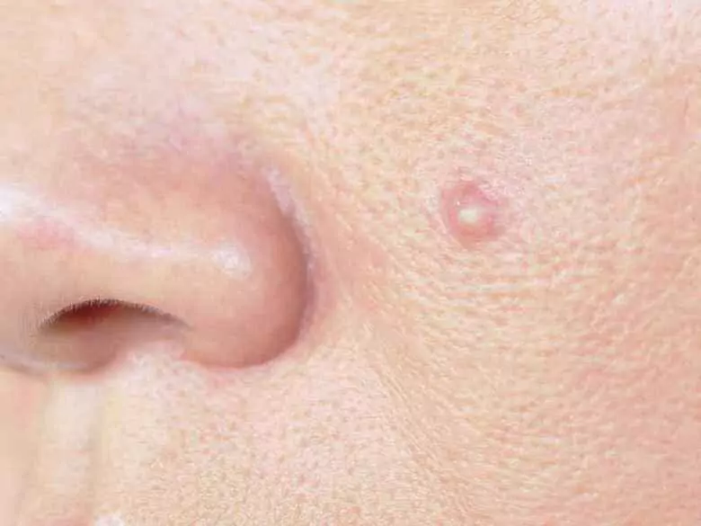 Atypische Formen der Rosazea