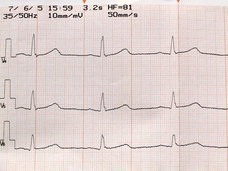 Herzrhythmusstörungen - Ursachen, Symptome, Diagnose, Behandlung