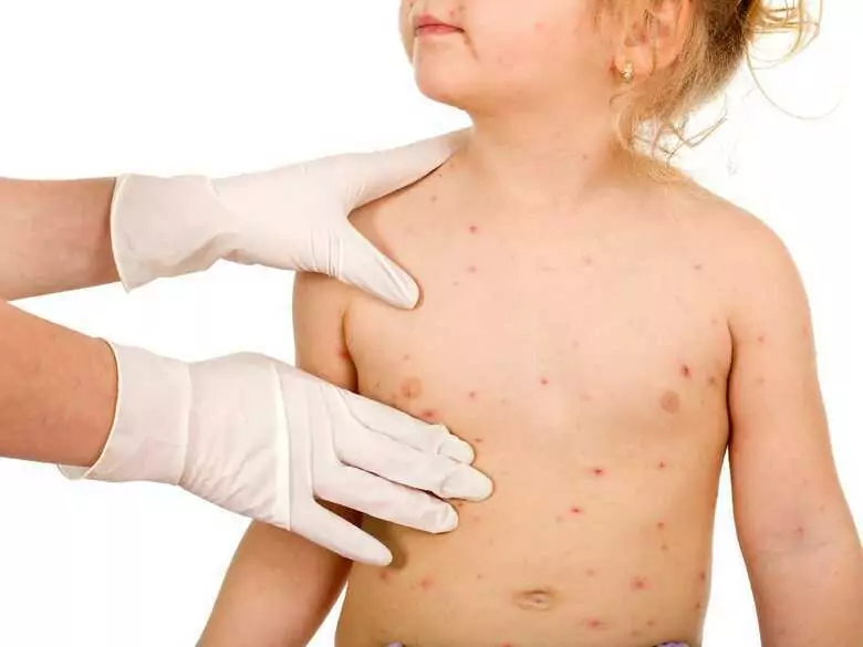 Hausmittel zur Linderung der Windpockensymptome