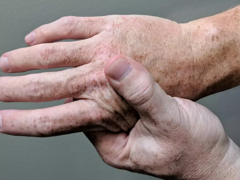 Wie geht man mit Arthritis-Problemen um?