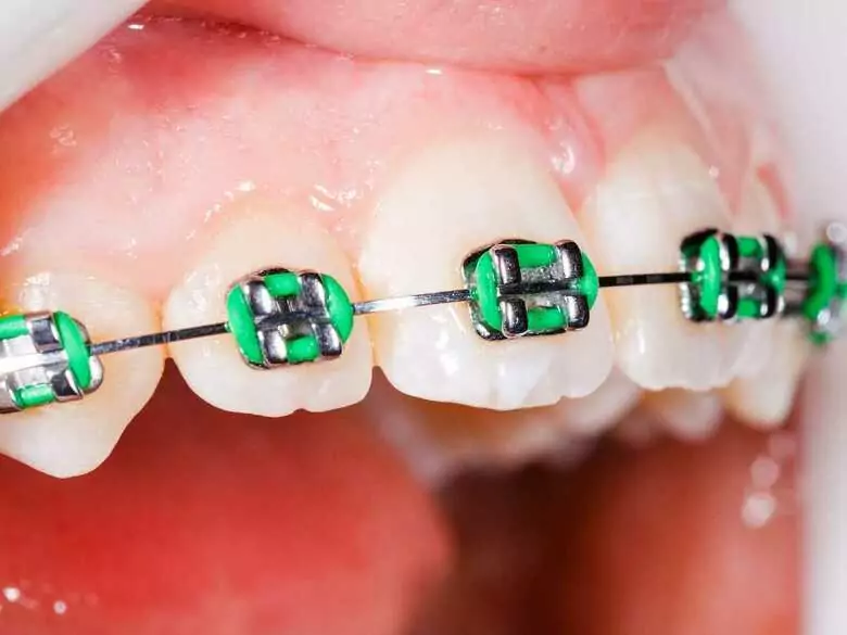 Ist zurückgehendes Zahnfleisch gefährlich?