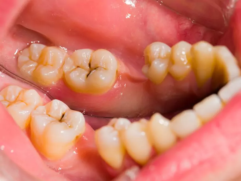 Karies-Risikofaktoren