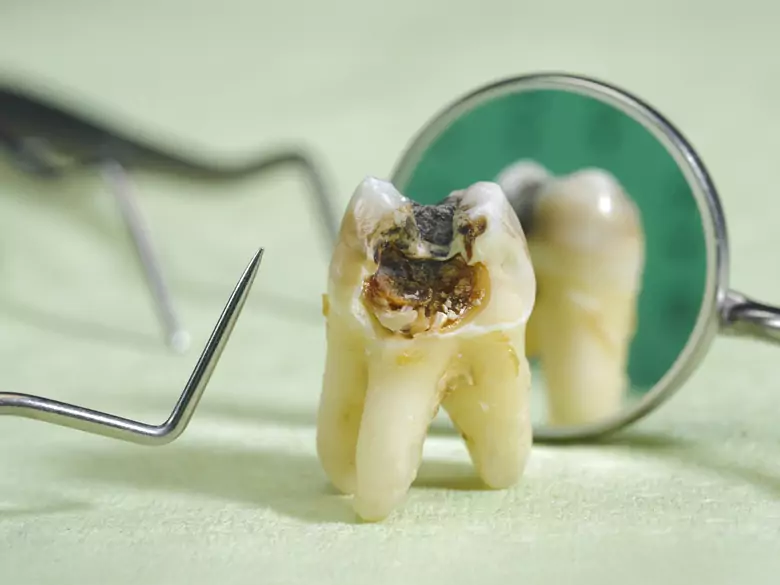  Verlagerung und Ausbruch der Milchzähne - Ursachen, Symptome, Diagnose, Behandlung