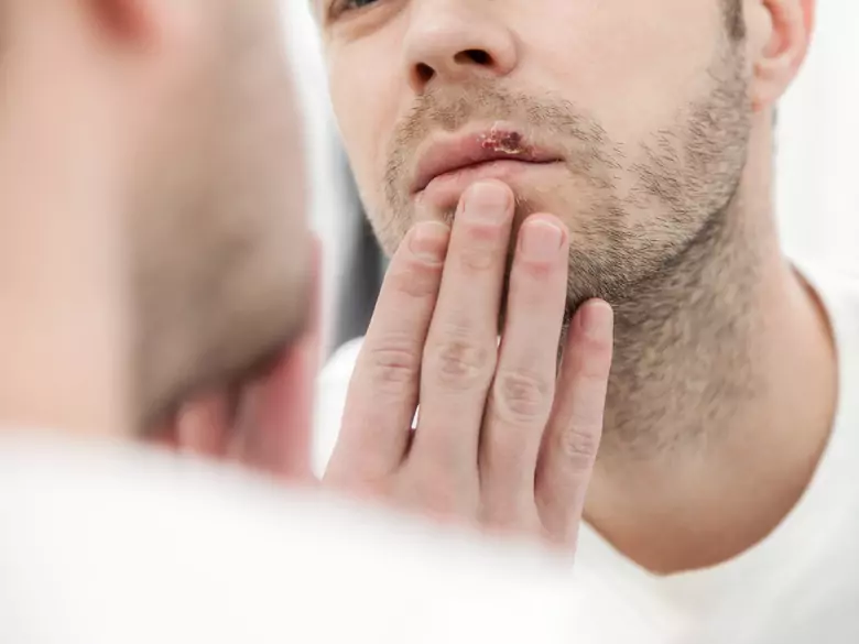 Wie behandelt man Herpes?