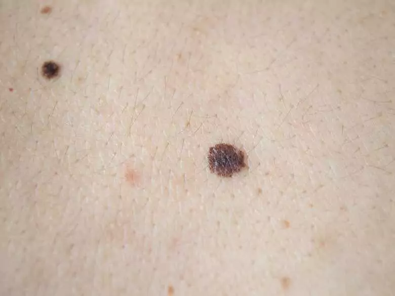 Selbstuntersuchung der Haut: Warum sollte sie durchgeführt werden und worauf ist zu achten?